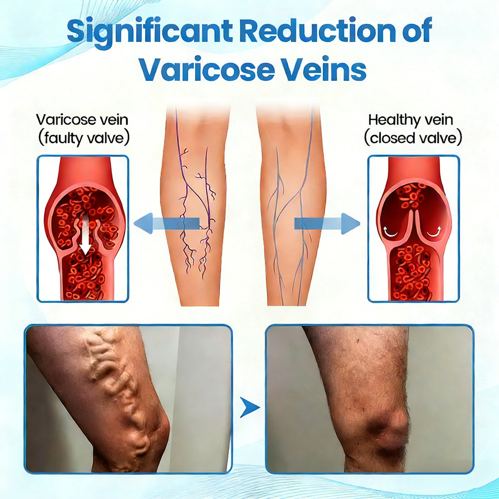 🇺🇸🏆✅🌿GFOUK® VascuCare Vein Healing Spray(Designed for Varicose veins, Spider veins, Deep vein Thrombosis, Chronic venous insufficiency, Venous ulcers, Thrombophlebitis and other venous issues)