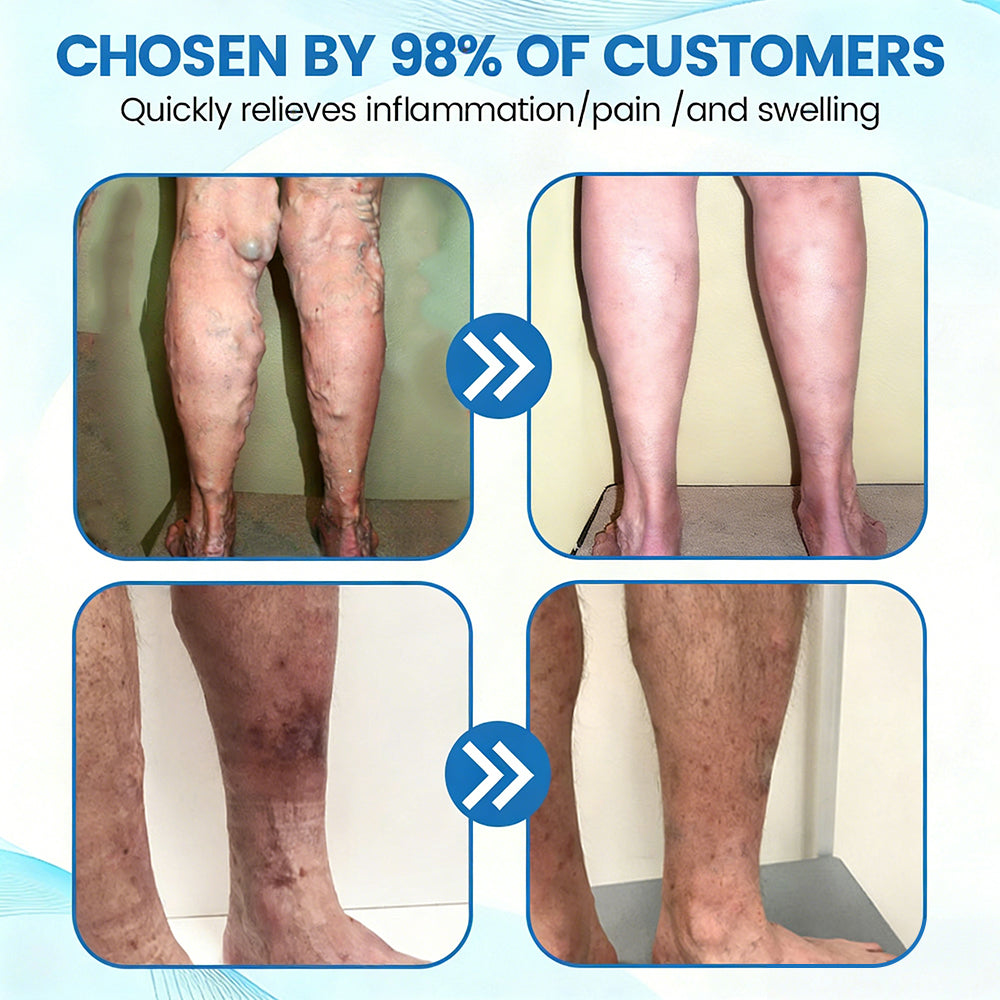 🇺🇸🏆✅🌿GFOUK® VascuCare Vein Healing Spray(Designed for Varicose veins, Spider veins, Deep vein Thrombosis, Chronic venous insufficiency, Venous ulcers, Thrombophlebitis and other venous issues)