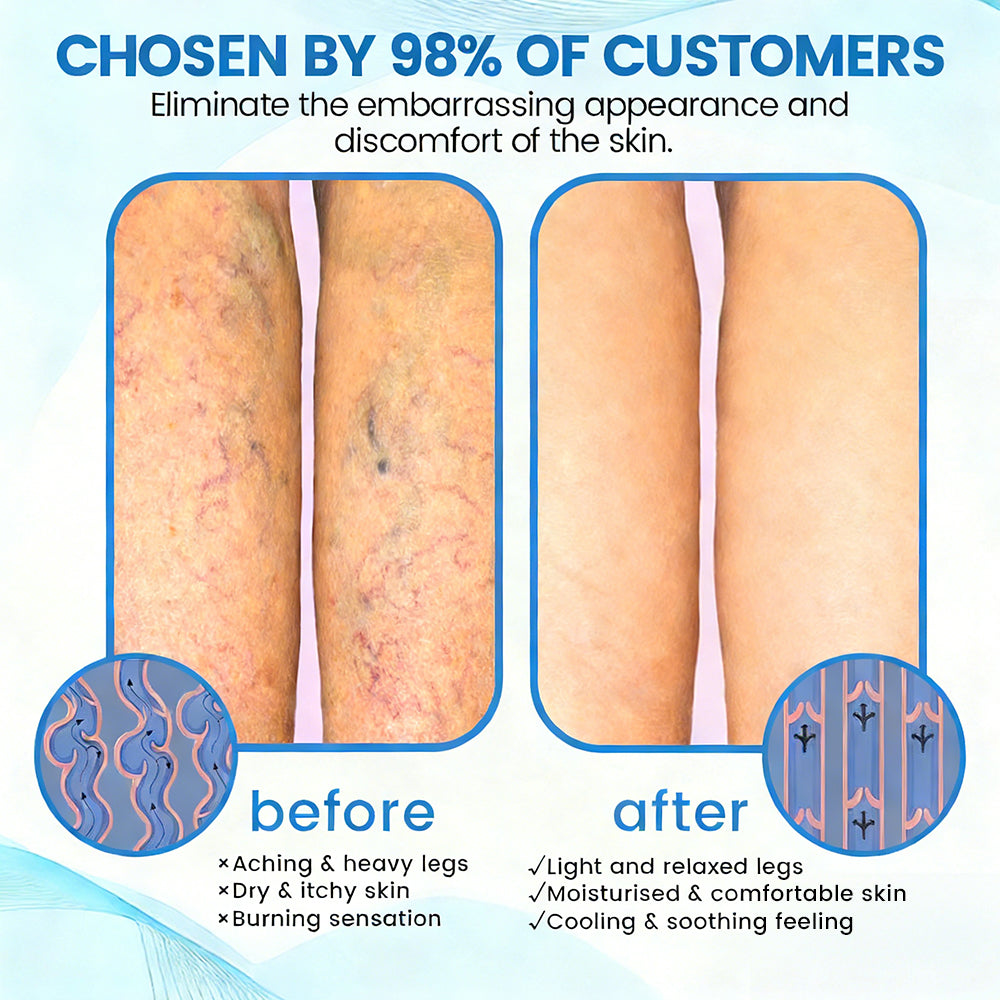 🇺🇸🏆✅🌿GFOUK® VascuCare Vein Healing Spray(Designed for Varicose veins, Spider veins, Deep vein Thrombosis, Chronic venous insufficiency, Venous ulcers, Thrombophlebitis and other venous issues)