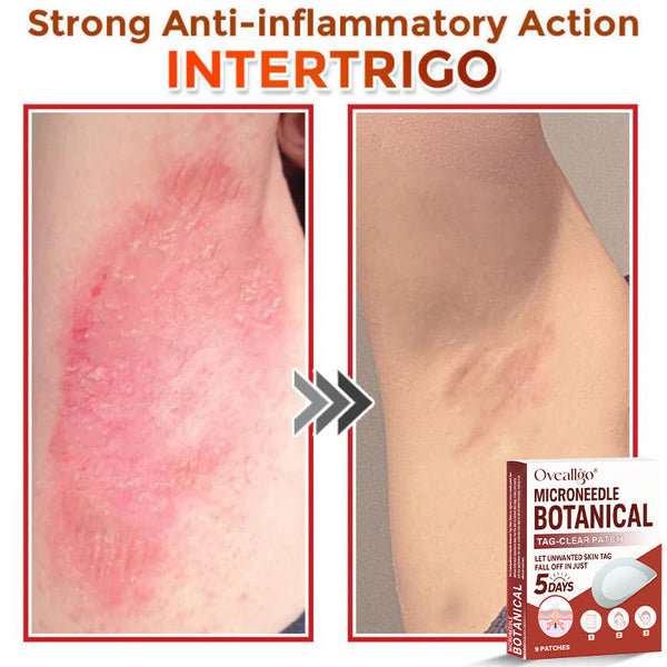 Oveallgo® MicroNeedle Botanical Tag-Clear Patch 🇺🇸 Made in the USA