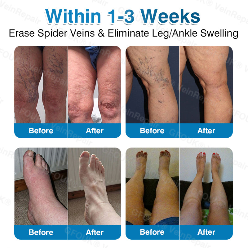 🇬🇧🥇👨‍⚕️⭐GFOUK® VeinRepair Microneedle Patch Roll⚡Instant Relief, Long-Term Results