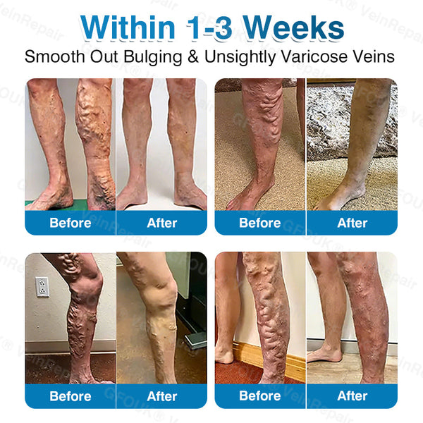 🇬🇧🥇👨‍⚕️⭐GFOUK® VeinRepair Microneedle Patch Roll⚡Instant Relief, Long-Term Results