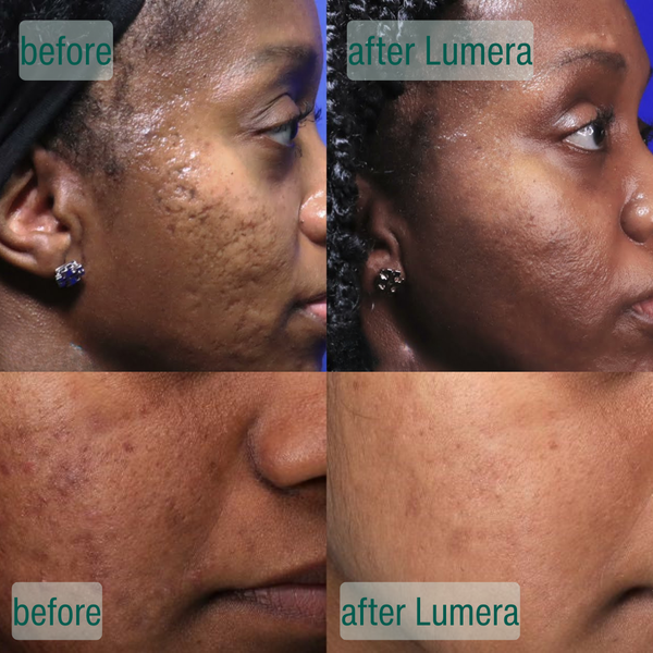 Microcrystal Serum PM Duo Fades Acne Scars Overnight
