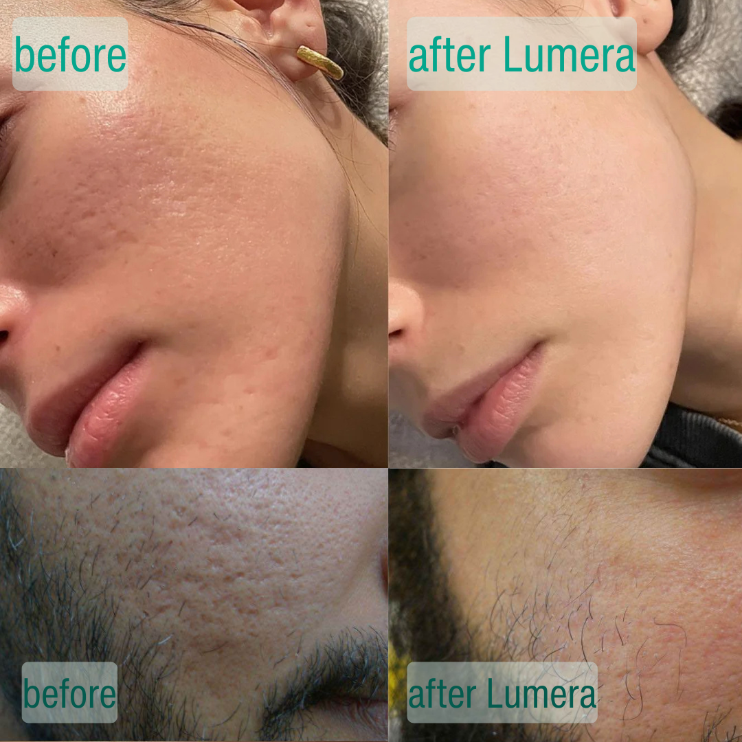 Microcrystal Serum PM Duo Fades Acne Scars Overnight