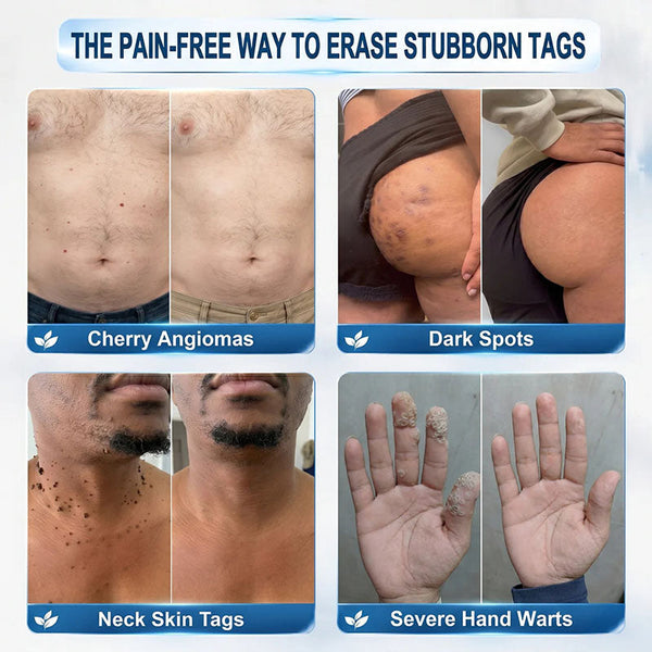 DermaRollix™ Skin Spot Removal Roller