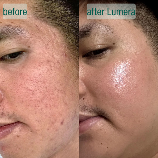 Microcrystal Serum PM Duo Fades Acne Scars Overnight
