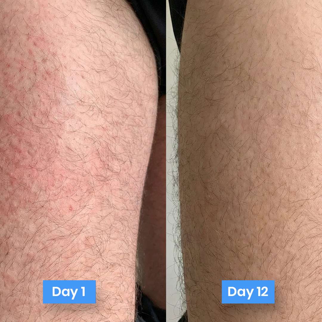 MycoShield™ Antifungal Defense Cream