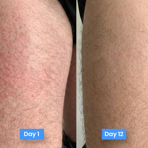 MycoShield™ Antifungal Defense Cream