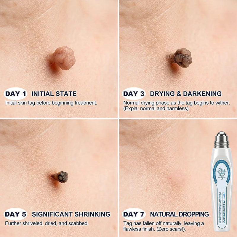 DermaRollix™ Skin Spot Removal Roller