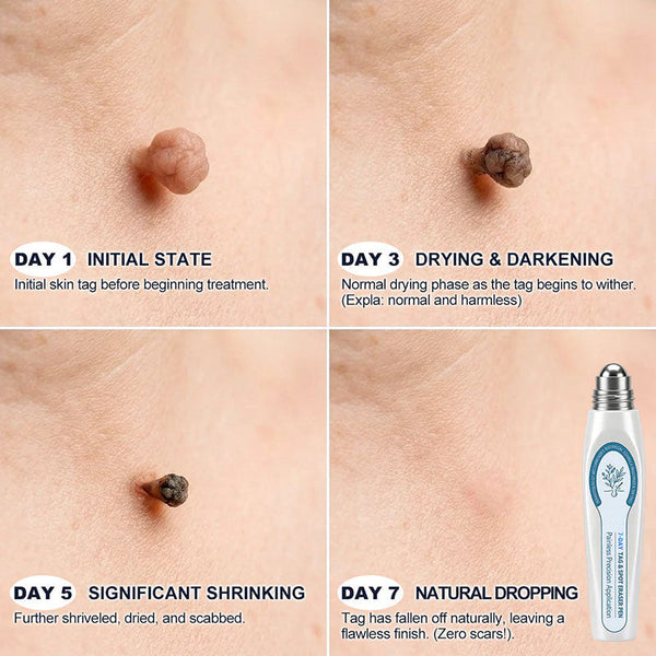 DermaRollix™ Skin Spot Removal Roller