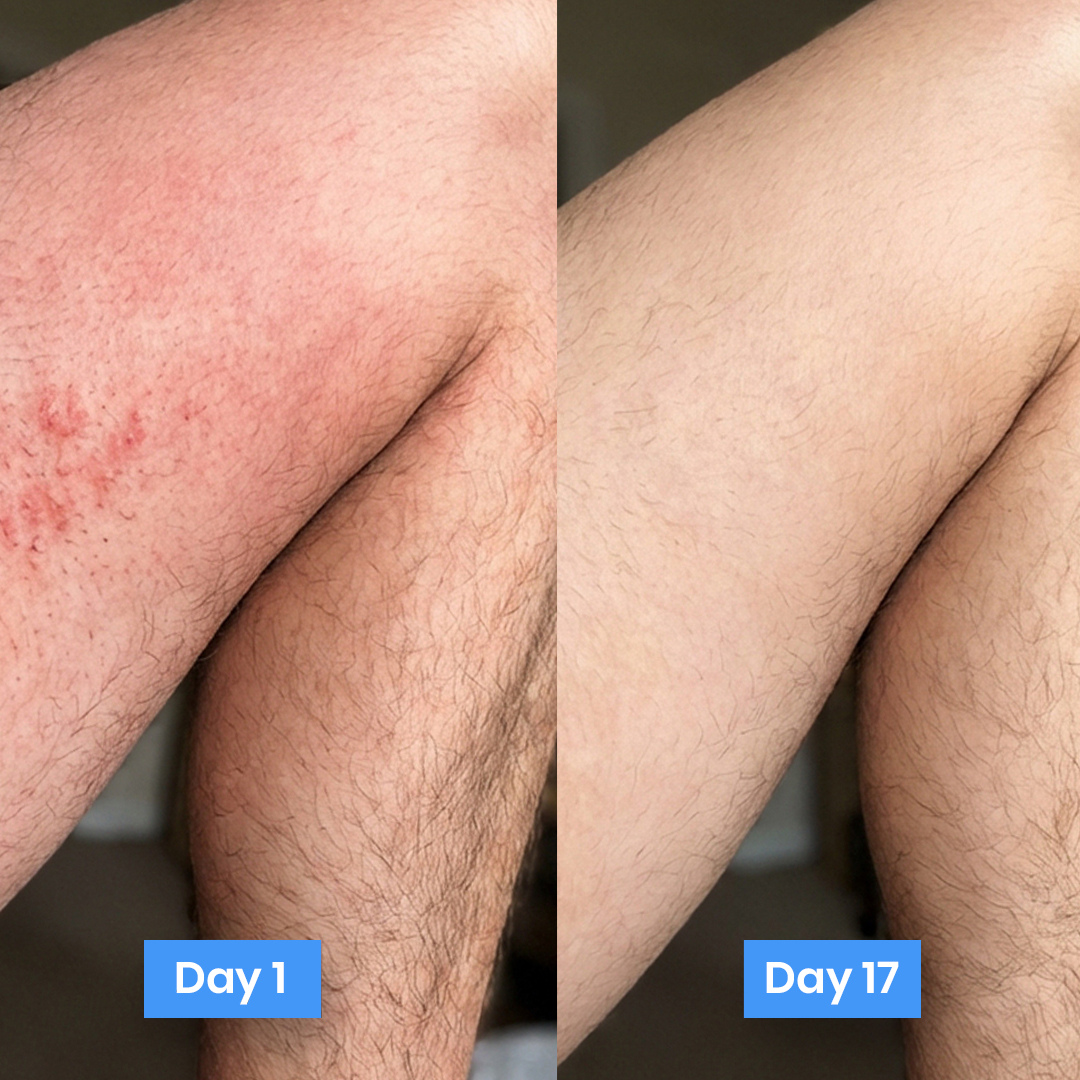 MycoShield™ Antifungal Defense Cream