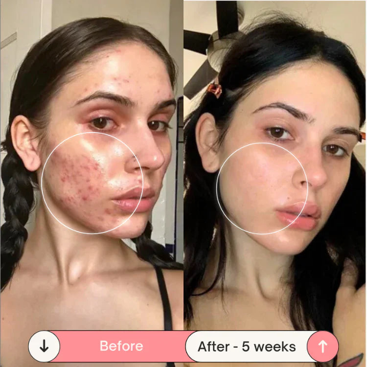 Acne-Proof Pillow + Pillowcase