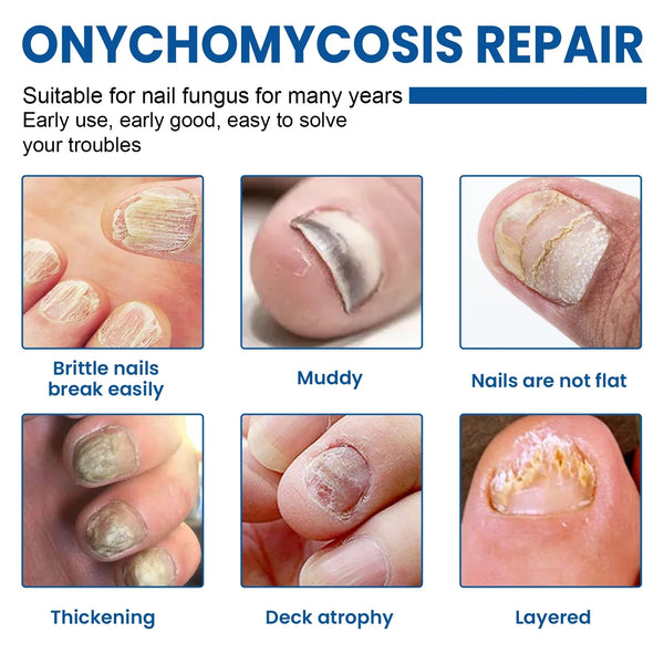 NailRevita™ Antifungal Repair Patches
