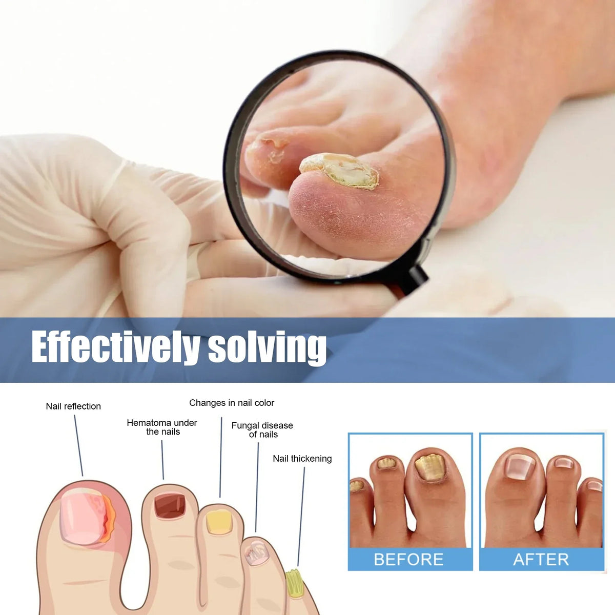 NailRevita™ Antifungal Repair Patches