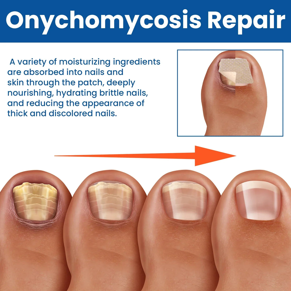 NailRevita™ Antifungal Repair Patches