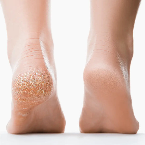 Nuvé™ Silk Pro | Smooth Feet in Minutes